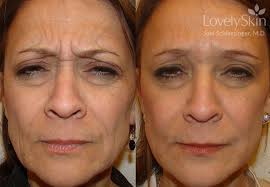Using dysport with certain other medicines may cause serious side effects. Omaha Cosmetic Surgery Dysport Skin Specialists Pc Lovelyskin