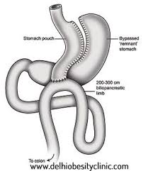 Http Delhiobesityclinic Com Mini Gastric Bypass Mini Gastric Bypass Surgery In Delhi Bariatria