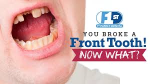 If you don't know how to fix a broken tooth yourself, hold the tooth between your cheek and gums till you see a dentist. Broken Front Tooth Now What 1st Family Dental Blog