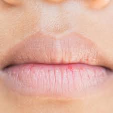 Bibir berwarna hitam atau gelap meski sudah memakai lip balm atau lip gloss memang agaknya mengganggu penampilan. Sudut Bibir Menghitam Bagaimana Cara Menghilangkannya