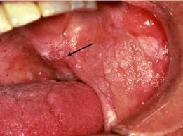 Image result for Erythroplakia roof of mouth