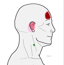 Understanding Trigger Points Headache In The Forehead With Images Trigger Points Headache Migraine