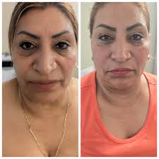 El Plasma Rico en Plaquetas...