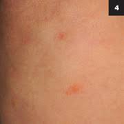 However, skin rashes can be caused. 2 Day Old Neonatal Patient With Rash