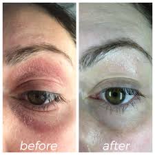 How long does seatworm infection last? How I Treated My Dermatitis Without Steroid Cream Justina S Gems