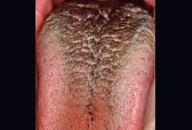 Seeing a black hairy tongue in the mirror can be unsettling. Black Hairy Tongue Sergio F Calleja Dds