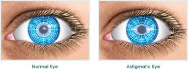 Some asians as well as others have a what is called an epicanthal (or epicanthic) fold in their upper eyelid and it makes the eye appear to be a different shape. Astigmatism Correction Surgery Astigmatism Treatment Astigmatism Laser Eye Surgery