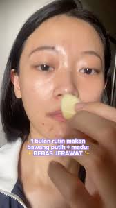 Eksperimen cobain makan bawang putih dicelup madu selama sebulan, berujung  bekas jerawat dan jerawat Mia makin dikittt 😭💕, Masih mau Mia lanjutin  nih biar lebih bebas jerawat lagi ke depannya!, ...