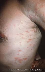 Consult a doctor for medical advice. Pityriasis Rosea A Z Of Skin