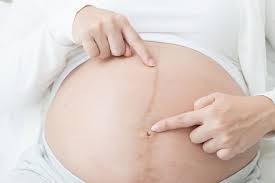 Ich bin jetzt in der 14. Linea Nigra Dunkler Streifen Auf Der Babykugel Eltern De