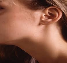 The lumps themselves are swollen lymph nodes, and they typically appear in the neck, armpit, or groin. Neck Lumps Dr John Chaplin Head And Neck Surgeon