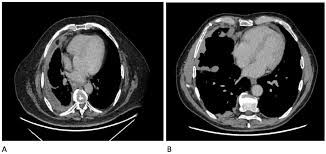 Conventional chest radiography and computed tomography (ct) scanning are the primary imaging modalities that are used for evaluation of all types of pleural. Diagnostics Free Full Text Diagnostics In Pleural Disease Html