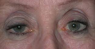 Image result for Pupillary Paralysis