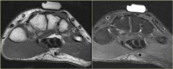 The majority of soft tissue lesions in the foot and ankle are benign. The Radiology Assistant Non Traumatic Changes