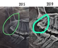 Saya berpengalaman mencuci gigi kami di desa murni dental clinic sungai dua pulau pinang. Pengalaman Cabut Gigi Bungsu 10 Menit Di Rs Jakarta Bayar Sendiri Look At Me