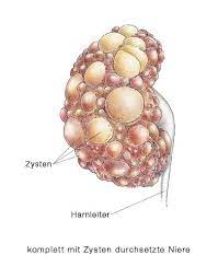 Zystennieren Zysten Nieren Eesom Gesundheitsportal