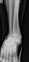 Image result for Subtalar Dislocation