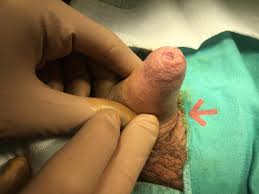 Fimosi e circoncisione del pene: sintomi, rischi e cura