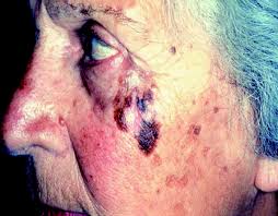 Image result for Solar Lentigo