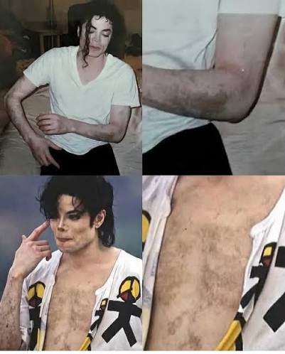 Michael Jackson openly lived with vitiligo, a skin condition that causes  loss of pigmentation in patches of the skin. Despite intense public  scrutiny, he continued to break barriers in music and entertainment,