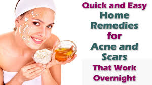 Best Home Remedies For Acne Overnight 6 Clear Acne Home Remedies Acne Is One Of The Most Common Skin Co Home Remedies For Acne Acne Remedies Acne And Pimples