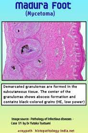 A rare pathology in morocco (about 15 cases) messoudi a, fnini s, el andaloussi y, charafeddine a, marouane s, ouarab m, largab a. 7 Infection Ideas