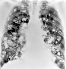 Image result for Broncholithiasis