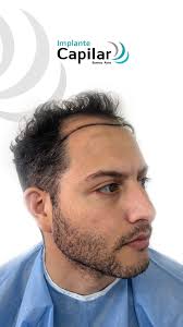 Dile Adiós al SUFRIMIENTO! , A Un Año de su implante capilar, nuestro  paciente Damián Stinco nos cuenta su experiencia!, No esperés más para  recuperar tu cabello!, Recuperá tu imagen y autoestima en ...