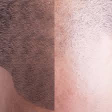 Welche methoden der haartransplantation gibt es in stuttgart? Ko Hair Haartransplantation In Deutschland Ko Hair