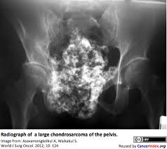 Image result for Chondrosarcoma