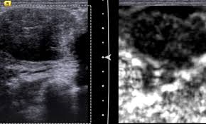Not all tumors are cancerous. Controversies And Practices In Breast Cancer Screening Healthcare In Europe Com