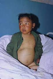 An original discovery: selenium deficiency and Keshan disease (an ...