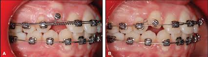 This facilitates eruption and orthodontic traction. Case Report Jco Online Journal Of Clinical Orthodontics