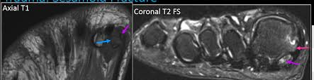 Muscles of the foot muscle origin insertion nerve supply extensor digitorum brevis distal part of the lateral and superior surfaces of the calcaneus and the apex of the inferior extensor. Https Skeletalrad Org Sites Default Files Pdf 50 20 20getting 20to 20your 20feet 20mr 20imaging 20of 20forefoot 20pain 20what 20the 20practicing 20radiologist 20needs 20to 20know Pdf