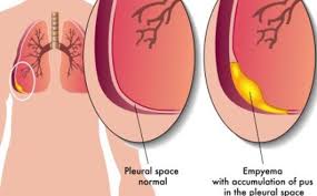 Image result for Thoracentesis