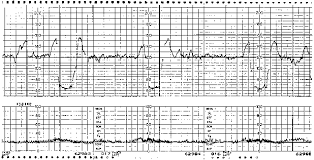 intrapartum fetal monitoring glowm