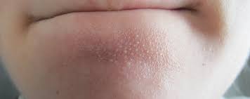 Не всё комедон, что из кожи торчит - сальные нити | Пикабу