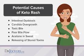 Keto Rash Causes And Natural Treatments Keto Rash Rash Treatment Natural Treatments