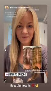 See how FullyVital hair products helped Dani Hamilton regrow thicker,  fuller hair. Her bald spot is getting covered up after using Fully Vital  for just 3 months! #hair #hairgrowth #hairgrowthtips ...