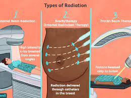 Radiation Therapy For Breast Cancer