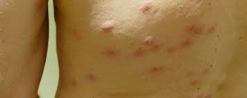 A professional pest controller should be engaged to ensure safe effective control of a bed bug infestation. Wb Pest Control Bedbugs Las Vegas Nv