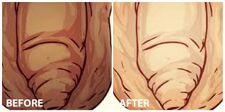 Maybe you would like to learn more about one of these? Genital Skin Whitening Whitening Laser