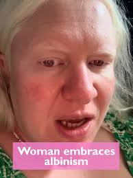 'My biggest wish in life is that no child with albinism grows up feeling  the way I did' (Via: SWNS