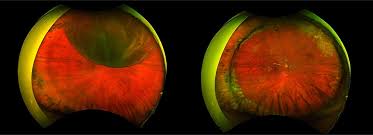 Learn more about the types, causes, risk factors, symptoms, diagnosis, treatment. Colorado Retina Retinal Tear Retinal Detachment