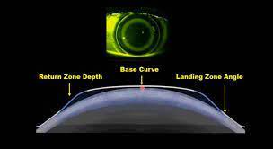 Orthokeratology Price Includes The Cost Of Fitting The Contact Lenses Instruction On Handling And Follow Up More Information Visit He Ocular Medicine Ortho