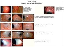 Image result for Scleritis