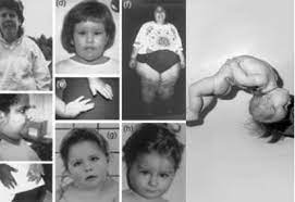 Prader a, labhart a, willi h. Sindrom Prader Willi Kelainan Genetis Yang Langka