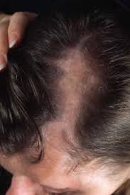 Caused them hair loss, but eliminating them from their diet helped hair to regrow but also become stronger and better in quality. Overcome Thyroid Hair Loss Los Angeles Hair Restoration Bhrc
