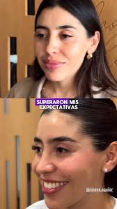 Testimonios by Dr. Javier Garnica. , De la vista nace el amor; marcaje  mandibular, corrección de jowls y lipo de papada. , En este perfil…seguimos  TRANSFORMANDO VIDAS. , #lipodepapada ...