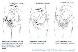 Image result for External Cephalic Version